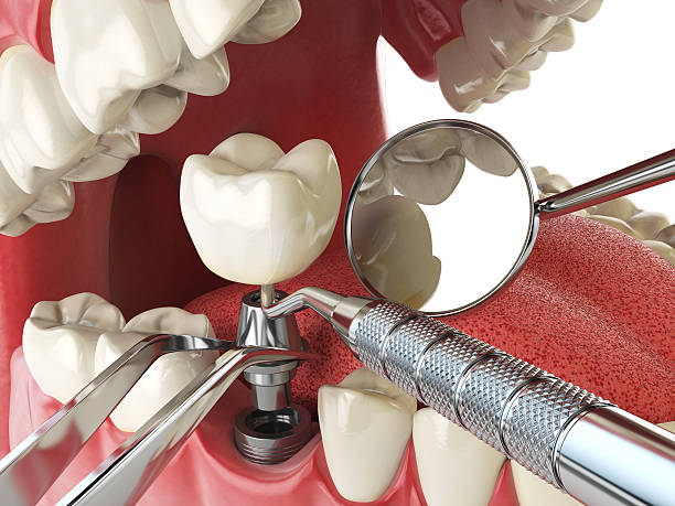 Best Knocked-Out Tooth Emergency  in Richwood, TX